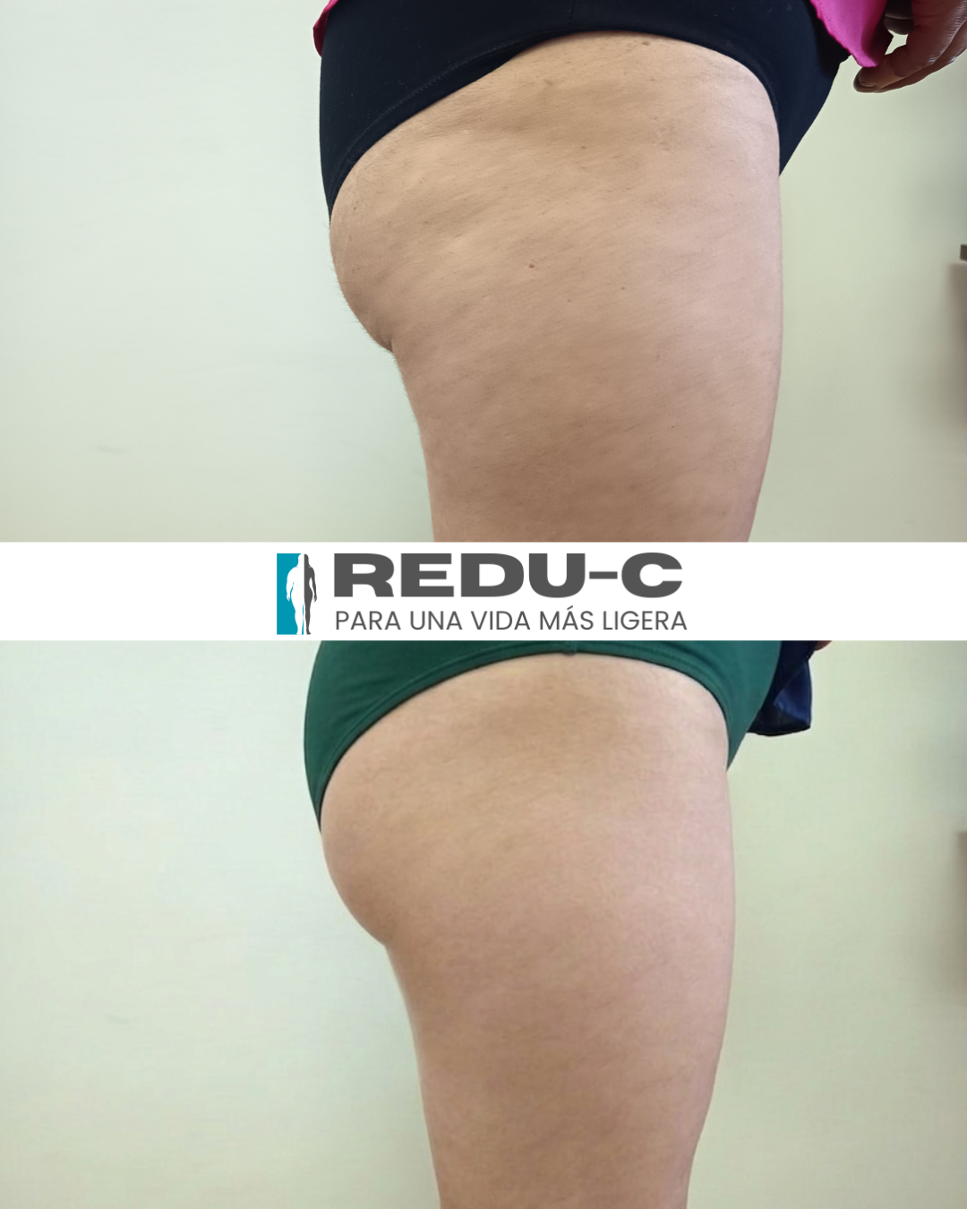 ¿Por qué la celulitis es más frecuente en las mujeres? La ciencia explica qué hay detrás de la “piel de naranja”